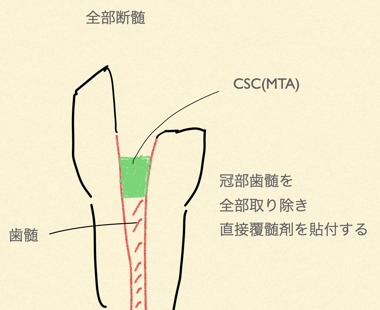 VPT(Vital Pulp Therapy)歯の神経を最大限残す治療