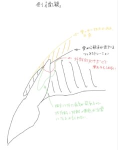 根尖部フェネストレーション（開窓）