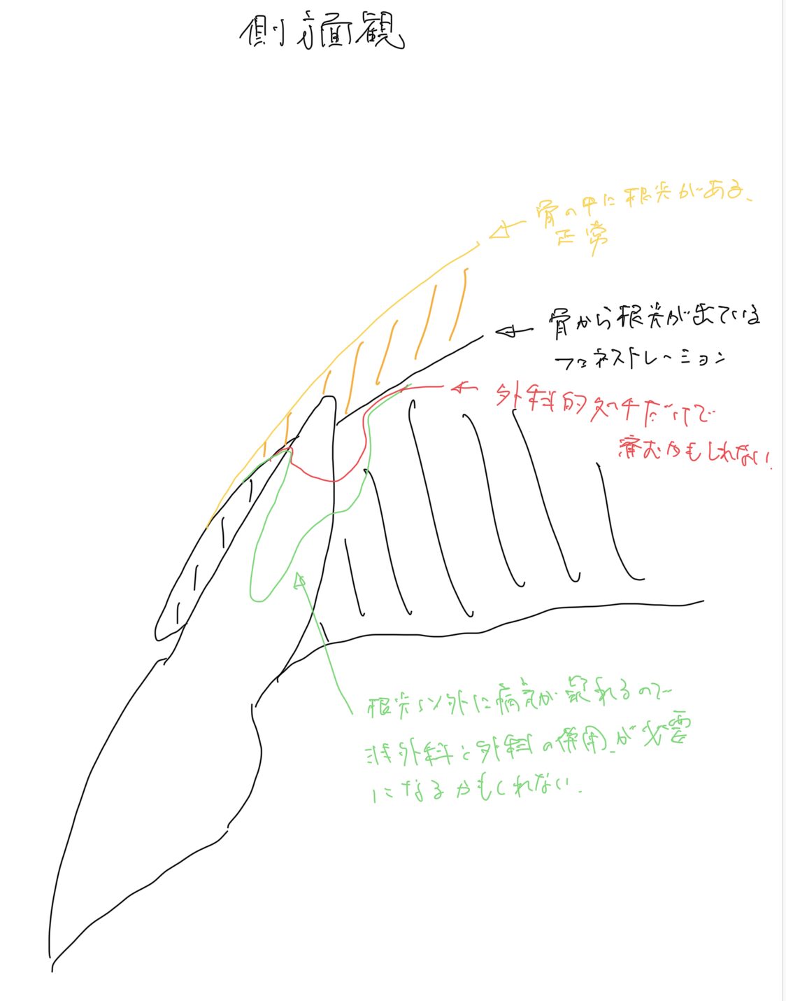 根尖部フェネストレーション(開窓)